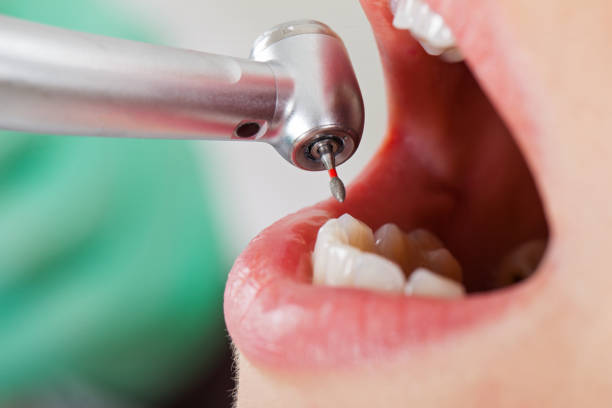 Best Emergency Root Canal Treatment in Percy, IL